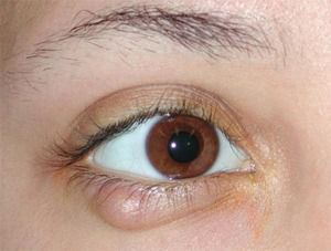 Calázio e hordéolo (terçol): Causas Sintomas e Tratamentos – EYECOLORS –  Vison Care