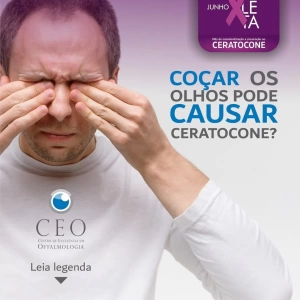 👁️ Coçar os olhos pode causar ceratocone? Sim, pode! E muita gente não sabe disso.  O ceratocone é uma doença que afina e deforma a córnea, comprometendo a visão. O hábito de coçar os olhos com frequência — especialmente com força — pode agravar ou até desencadear esse problema, principalmente em quem já tem predisposição genética.  ⚠️ Fique atento a sintomas como visão embaçada, sensibilidade à luz e troca frequente de óculos.  ✅ Quanto antes for diagnosticado, melhor o controle e o tratamento.  💜 Junho Violeta - Mês de conscientização e prevenção do Ceratocone.  📅 Agende sua avaliação no CEO – Centro de Excelência em Oftalmologia  📲 (37) 3237-4600 📲 (37) 3237-4602 📲 (37) 3237-4605  #JunhoVioleta #Ceratocone #SaúdeOcular #PrevençãoÉTudo #VisãoClara #CuidarÉPrevenir #Oftalmologia #CEOOftalmologia #CEO #parademinas #mg