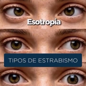 👁️ Outubro também é um mês de atenção à saúde dos olhos!  A Campanha de Conscientização sobre a Ambliopia chama a atenção para uma condição conhecida popularmente como “olho preguiçoso”, que pode estar associada ao estrabismo, especialmente na infância.  O estrabismo pode se apresentar de diferentes formas, conforme a direção do desvio ocular:  🔹 Esotropia – desvio para dentro 🔹 Exotropia – desvio para fora 🔹 Hipertropia – desvio para cima 🔹 Hipotropia – desvio para baixo  E uma informação importante: o estrabismo tem tratamento! Dependendo de cada caso, a cirurgia pode fazer parte das possibilidades de correção.  Durante a avaliação oftalmológica, são analisados fatores como o tipo e a intensidade do desvio, sua estabilidade e as características individuais de cada paciente para definir a abordagem mais adequada.  Se o estrabismo interfere na sua visão, causa incômodo estético ou você deseja saber se há indicação cirúrgica, procure uma avaliação especializada.  📲 Clique no link da BIO e agende sua consulta no CEO – Centro de Excelência em Oftalmologia.