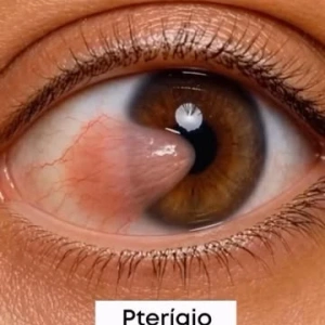 👁️ Olhos vermelhos, irritados ou visão embaçada? Nem sempre a causa é a mesma!  Existem diferentes condições que podem afetar a saúde ocular, e conhecer seus sinais é importante para buscar o cuidado adequado.  🔹 Conjuntivite: pode provocar vermelhidão, coceira, lacrimejamento e secreção.  🔹 Terçol: surge como um pequeno nódulo inflamado e dolorido na pálpebra.  🔹 Pterígio: crescimento de um tecido sobre a superfície do olho, que pode causar irritação e afetar a visão.  🔹 Hemorragia subconjuntival: aparece como uma mancha vermelha intensa no olho e, na maioria das vezes, não representa gravidade.  🔹 Catarata: provoca a perda gradual da transparência do cristalino, deixando a visão cada vez mais turva.  🔹 Queimadura ocular: pode causar dor, vermelhidão e sensibilidade à luz, exigindo avaliação imediata.  ⚠️ Atenção! Sintomas semelhantes podem ter causas diferentes. Por isso, evite a automedicação e procure um oftalmologista para uma avaliação adequada.  E você, já apresentou alguma dessas alterações? Conte nos comentários!  Agende sua consulta no CEO – Centro de Excelência em Oftalmologia  📲 (37) 3237-4600 📲 (37) 3237-4602 📲 (37) 3237-4605 . . #CEOftalmologia #Conjuntivite #Terçol #Catarata #Pterígio SaudeOcular