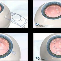 Implante de Lentes Fácicas para correção de Alta Miopia